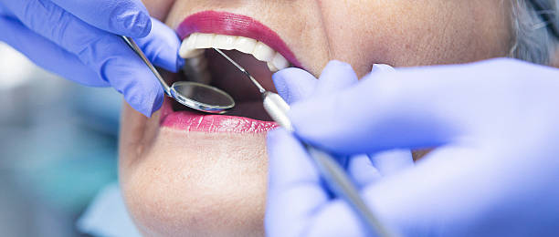 Best Emergency Dentist for Lost Fillings or Crowns in Huron, SD